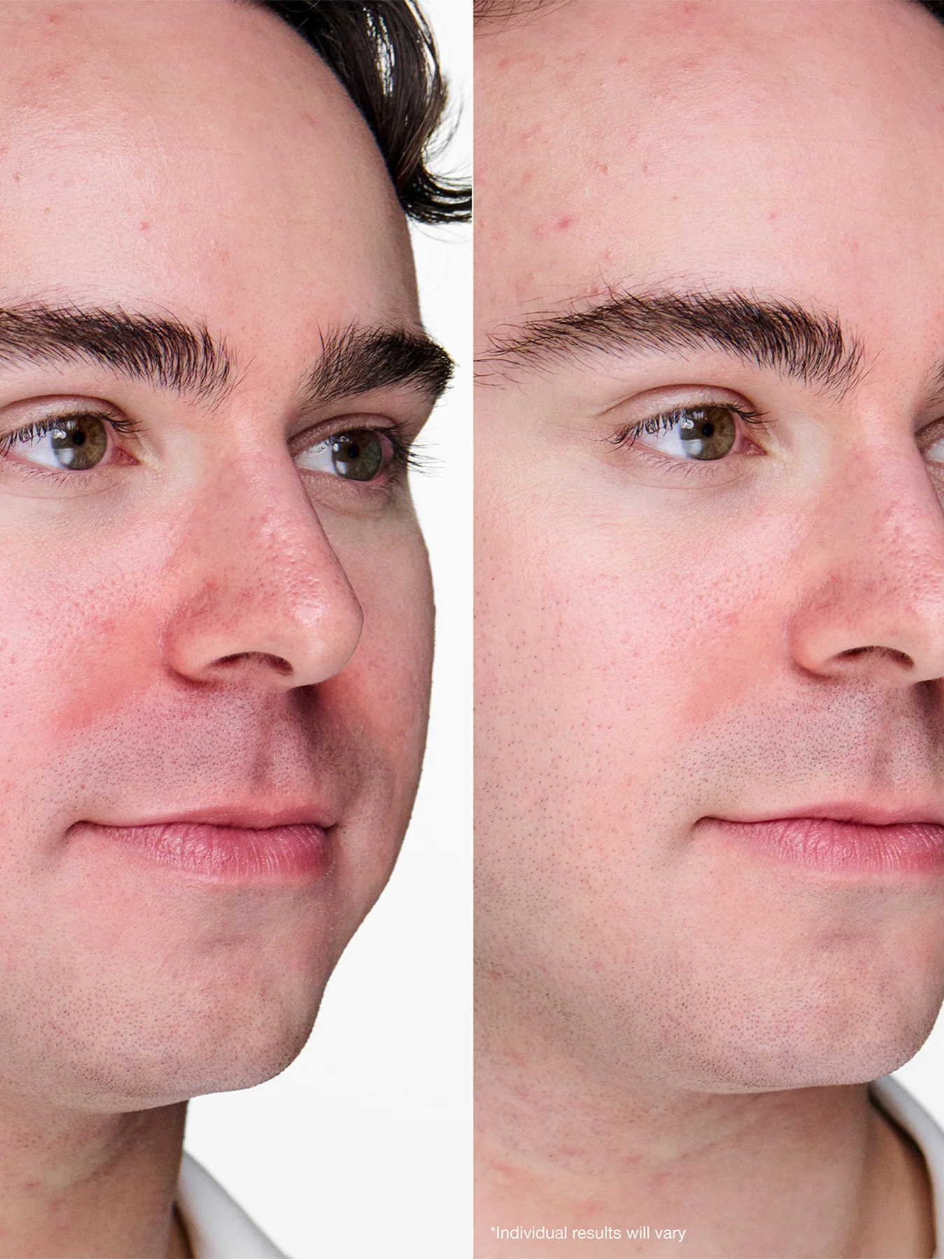 Anti Blemish Solutions Clinical Advanced Clearing Gel 10ml - Image 4